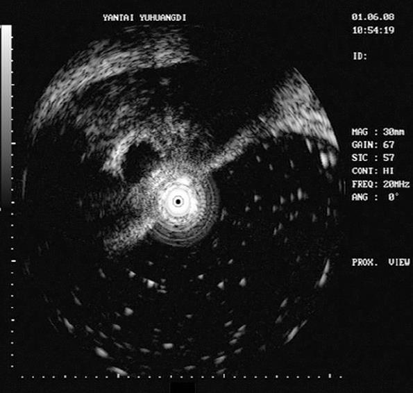 Gastric outlet obstruction caused by heterotopic pancreas: A case report and a quick review