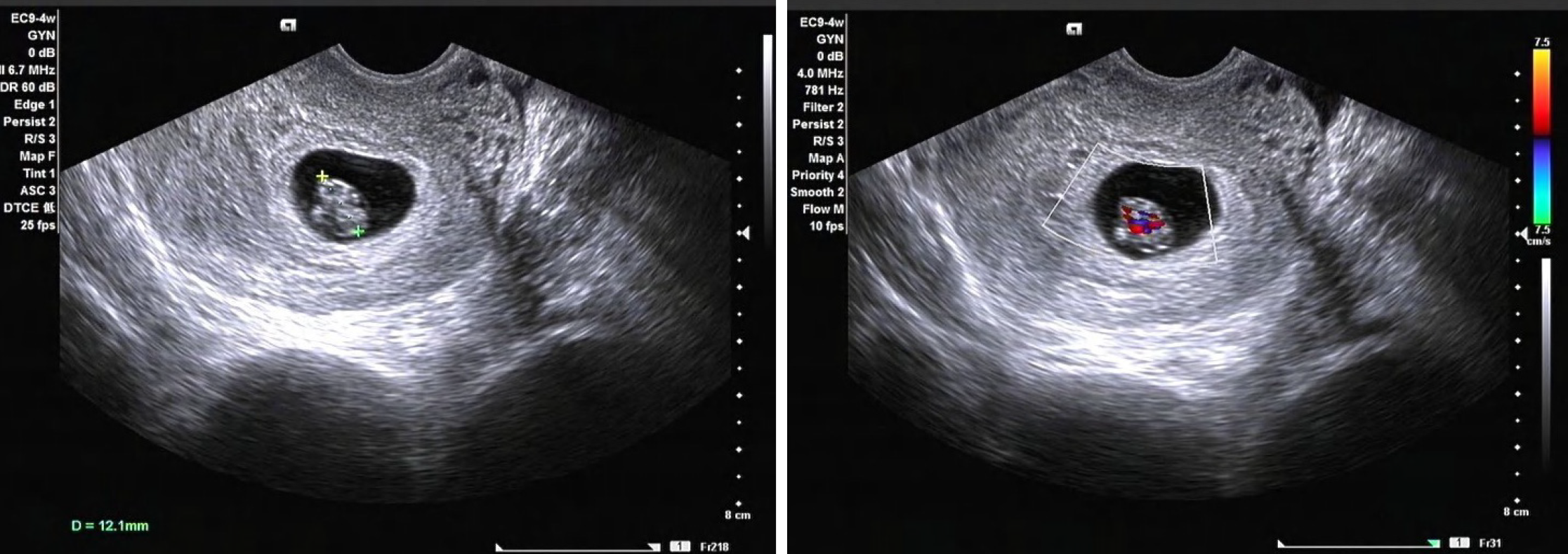 Figure 1 Ultrasound imaging of the embryo at seven weeks gestation. 