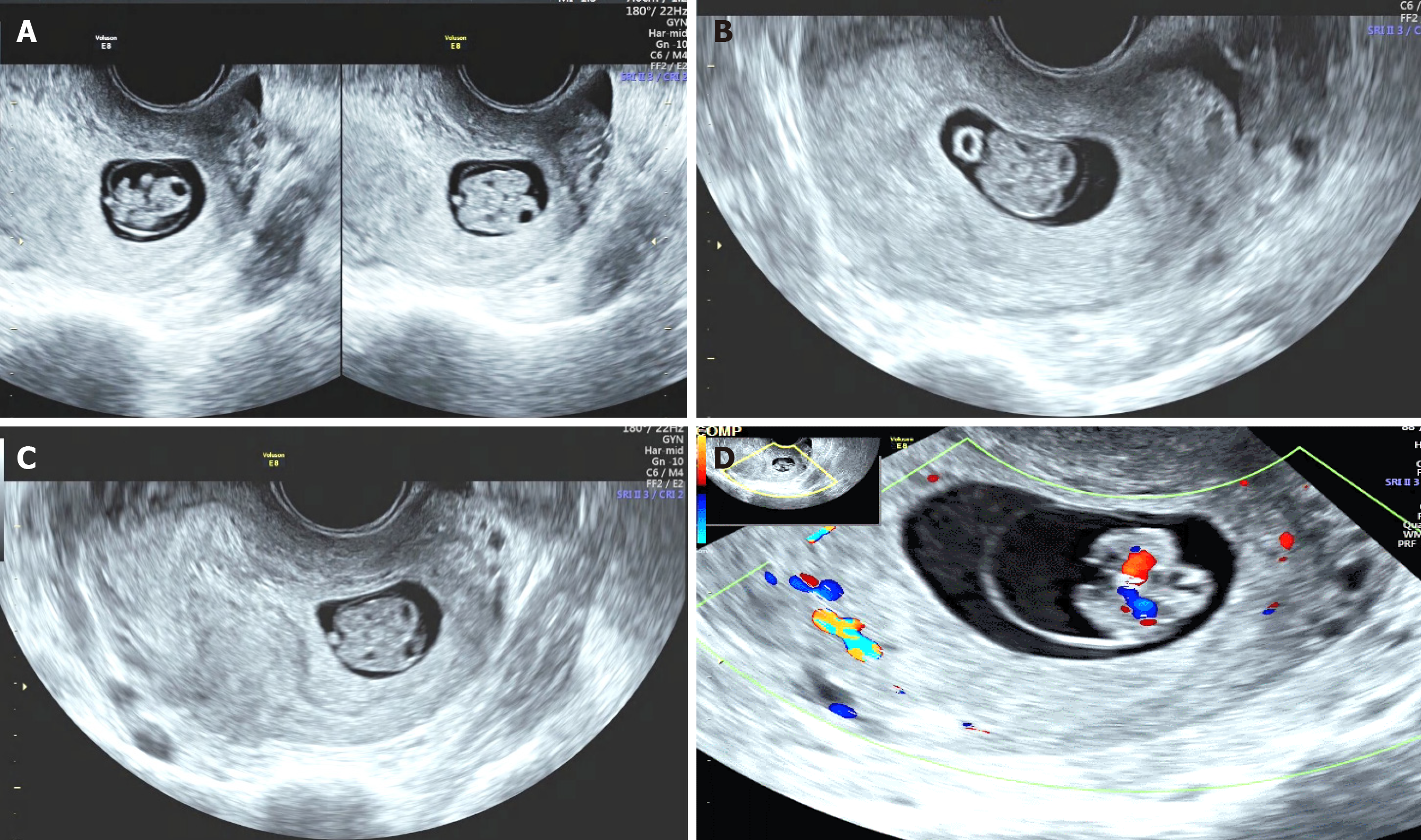 Twins 7 week ultrasound Monochorionic diamniotic