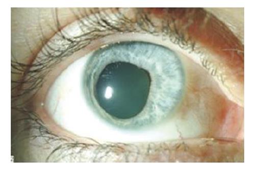 Ocular damage secondary to lights and lasers How to avoid and