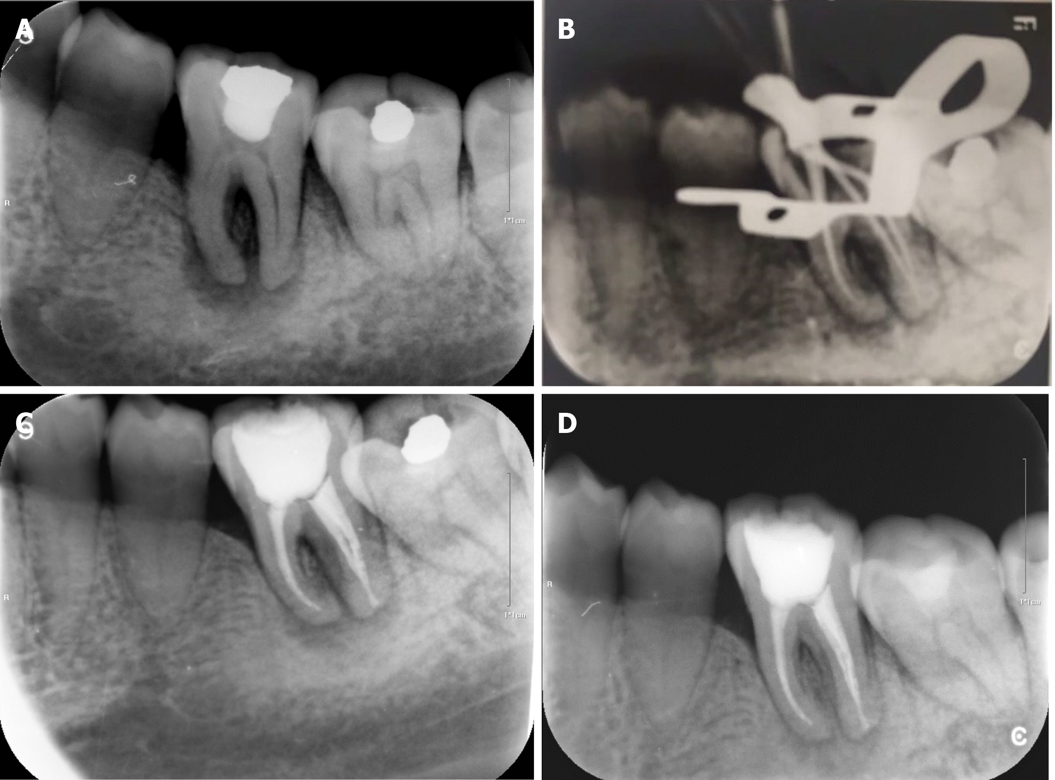 Periapical X Ray