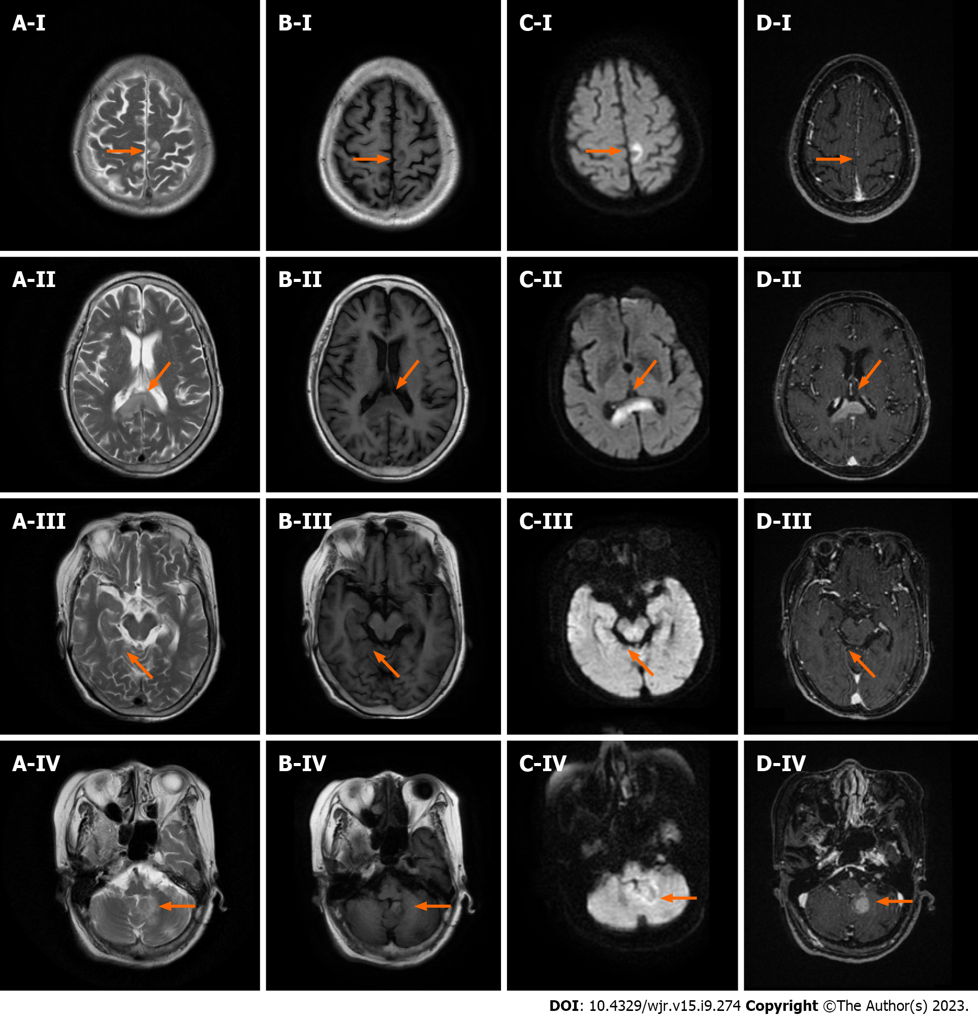 Distinctive magnetic resonance imaging features in primary central 