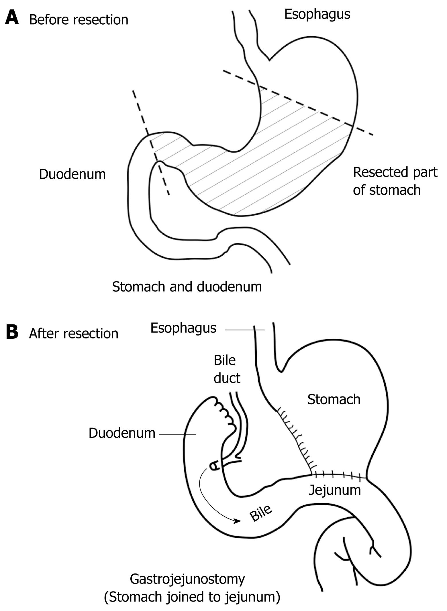 Difference Between Billroth I And Billroth Ii