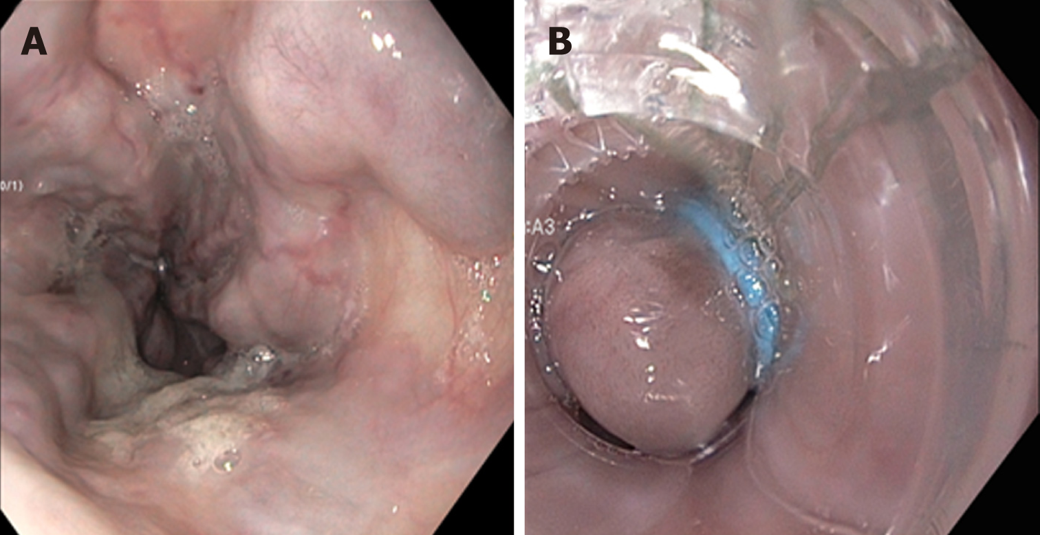esophageal varices rupture