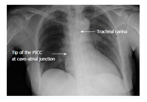 picc in innominate vein