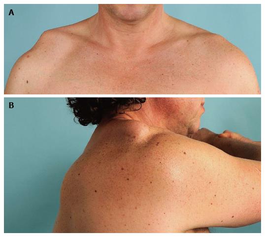 New insights in the treatment of acromioclavicular separation