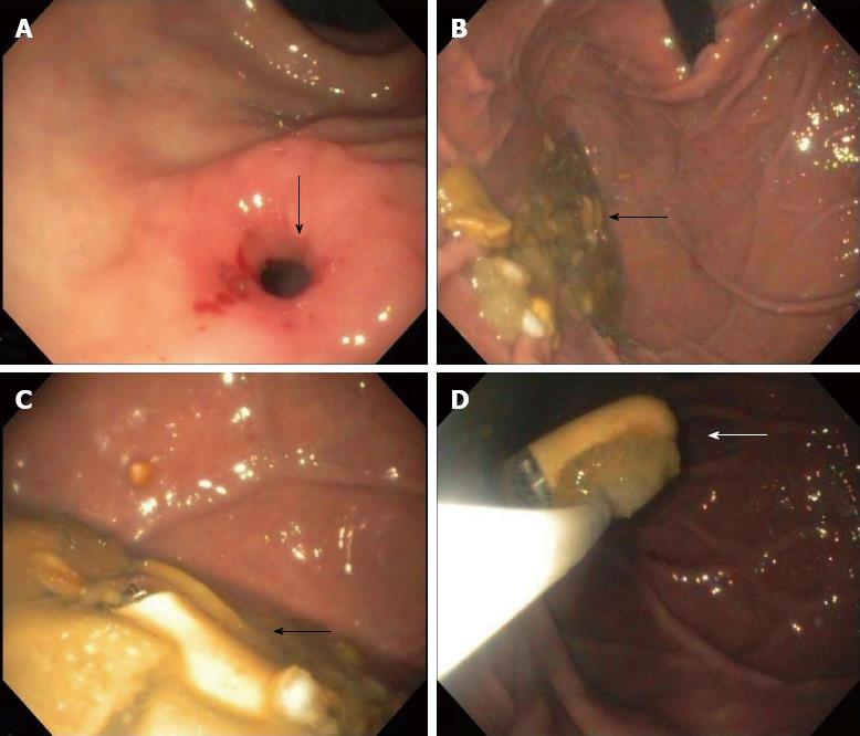 pyloric stenosis upper gi series