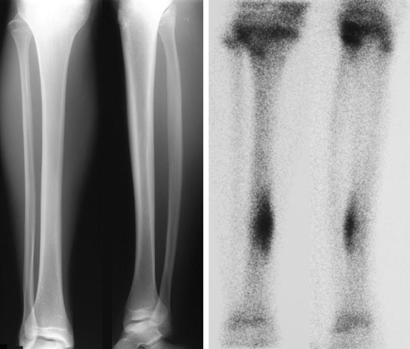 medial tibial stress syndrome bone scan