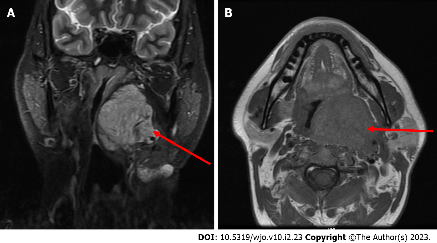 Transoral robotic surgery for adult parapharyngeal lymphangioma: A case ...