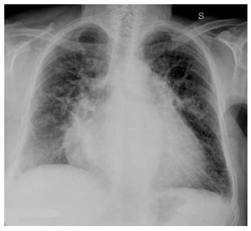 pulmonary edema chest x ray