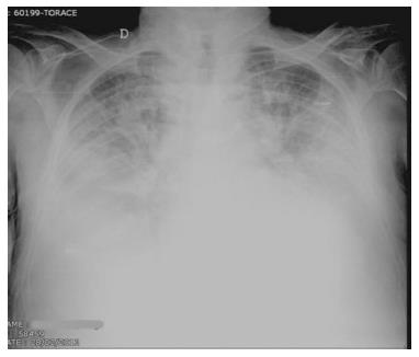 pulmonary edema chf chest x ray