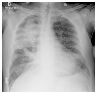 pulmonary edema chf chest x ray