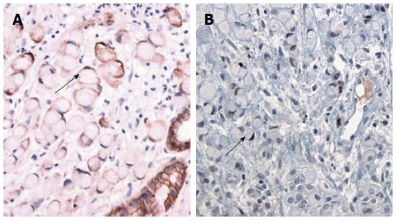 Breast metastasis of gastric signet-ring cell carcinoma: a case report and  literature review | World Journal of Surgical Oncology | Full Text