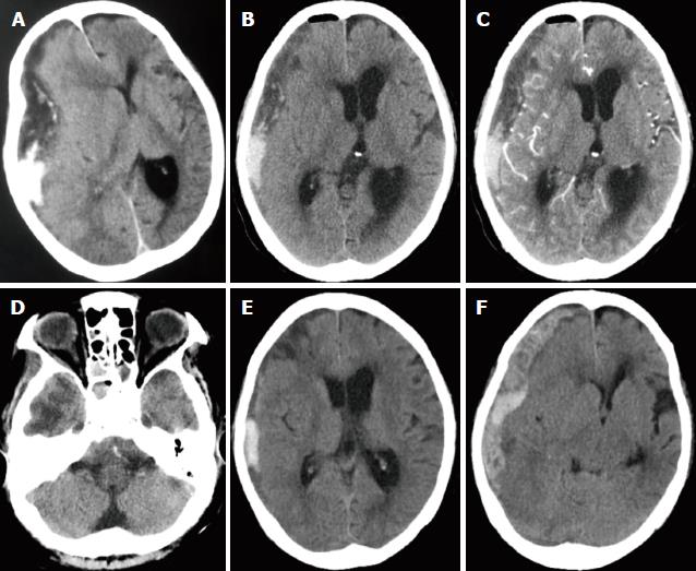 Subdural empyema complicated with intracranial hemorrhage in a ...