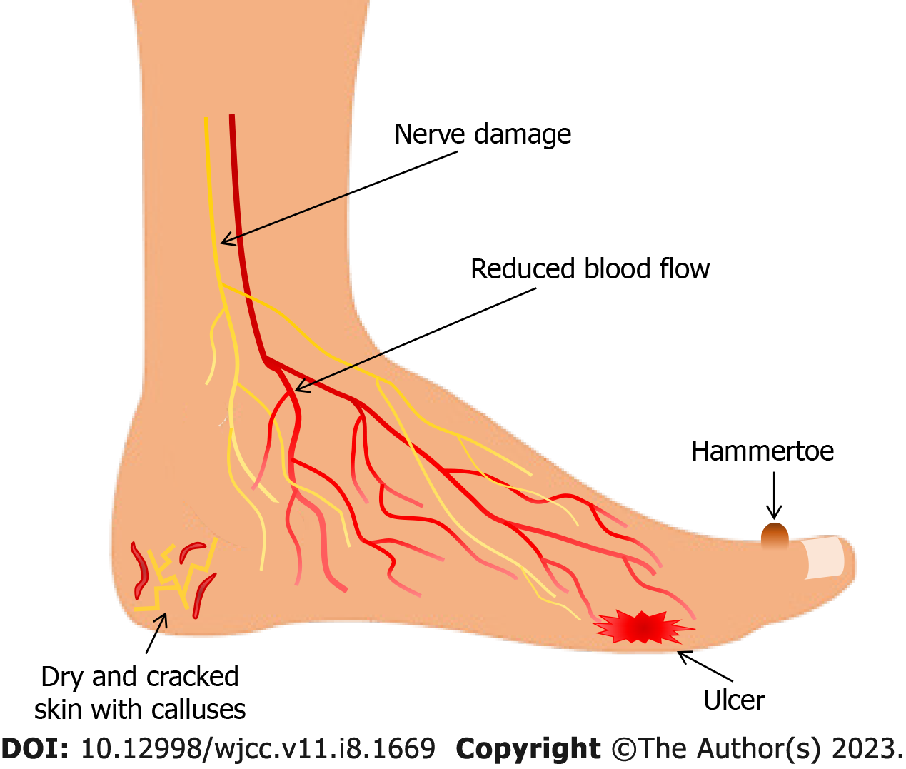 understanding-the-multifaceted-etiopathogenesis-of-foot-complications