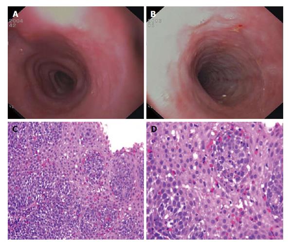 Eosinophilic Esophagitis From Pathophysiology To Treatment 0659