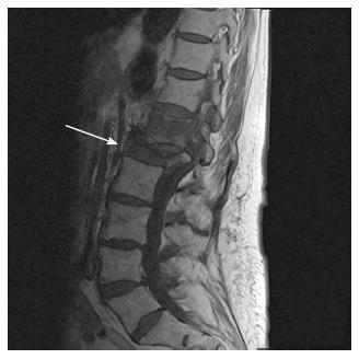 pathological fracture spine