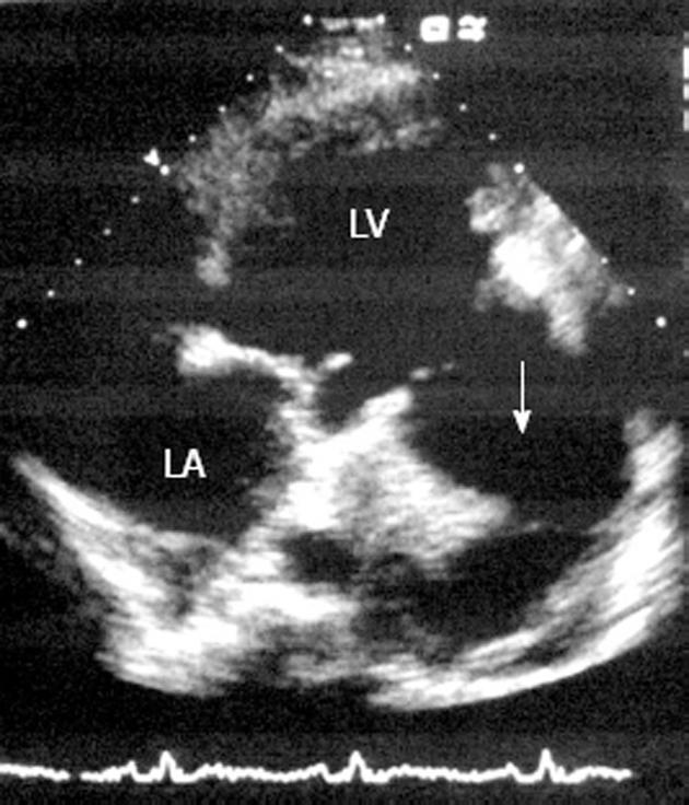 Giant left ventricular pseudoaneurysm presenting with hemoptysis