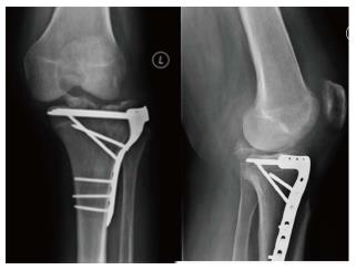 Multiligament Knee Injuries With Associated Tibial Plateau