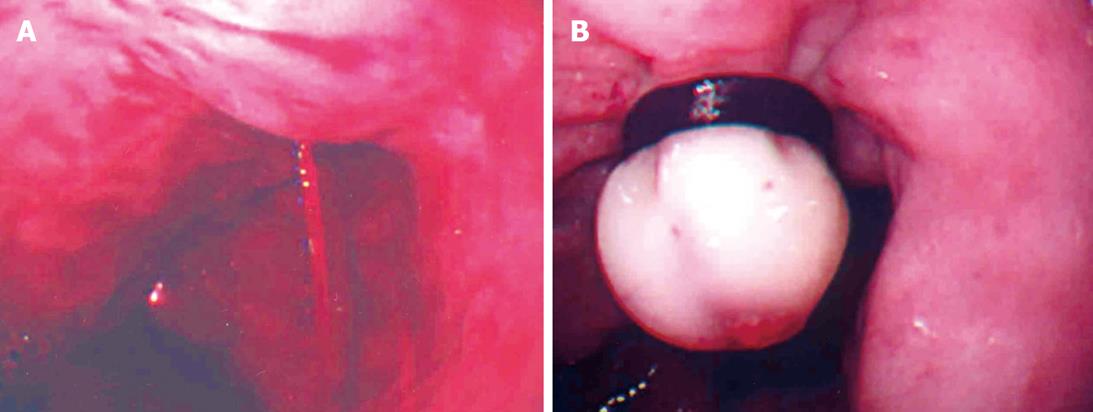 endoscopic evl