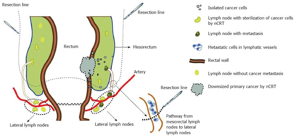 rectal cancer recurrence