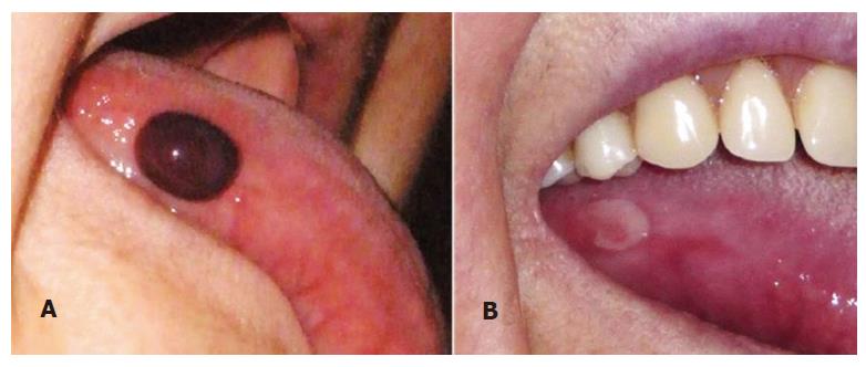 causes of blood blisters in mouth