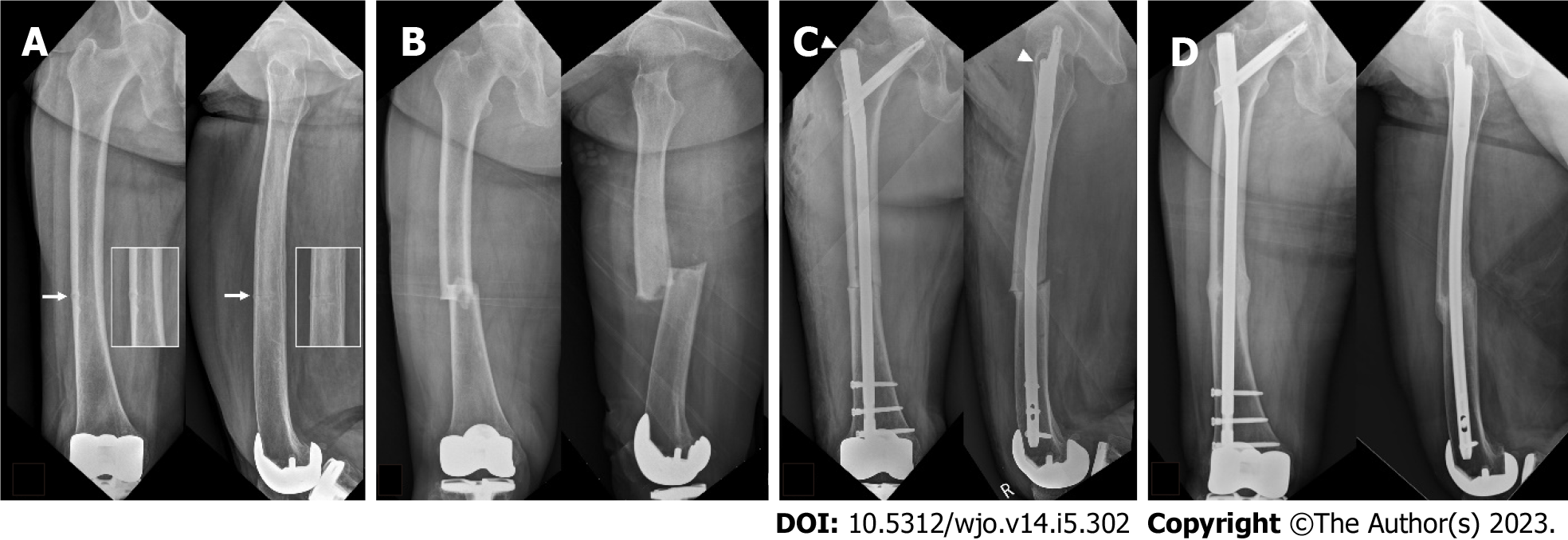 Intramedullary Nails | Flexible Intramedullary Nailing Systems for all  Fractures: Madison Ortho