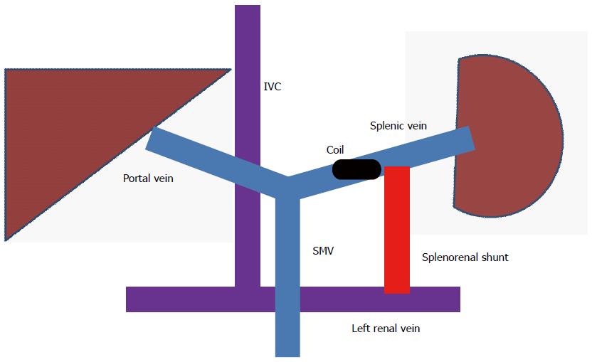 splenorenal shunt