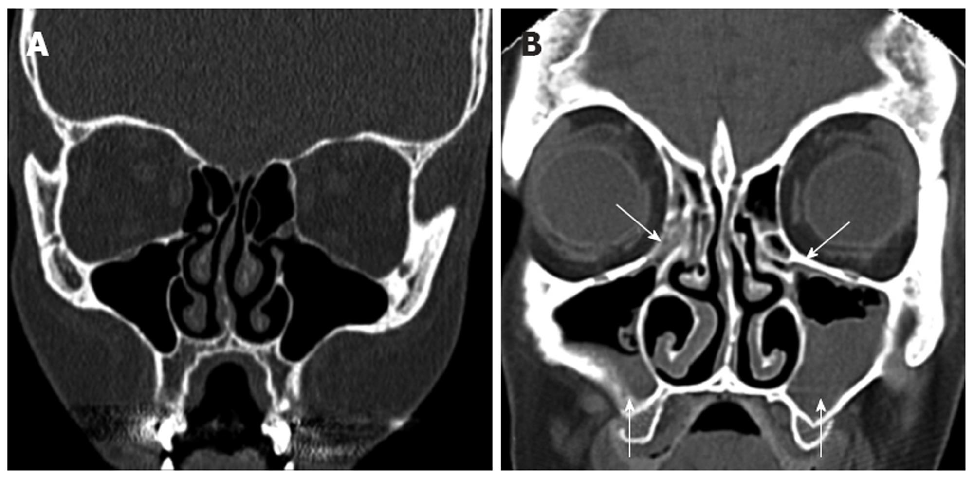 Computed tomography scans of paranasal sinuses before functional endoscopic surgery