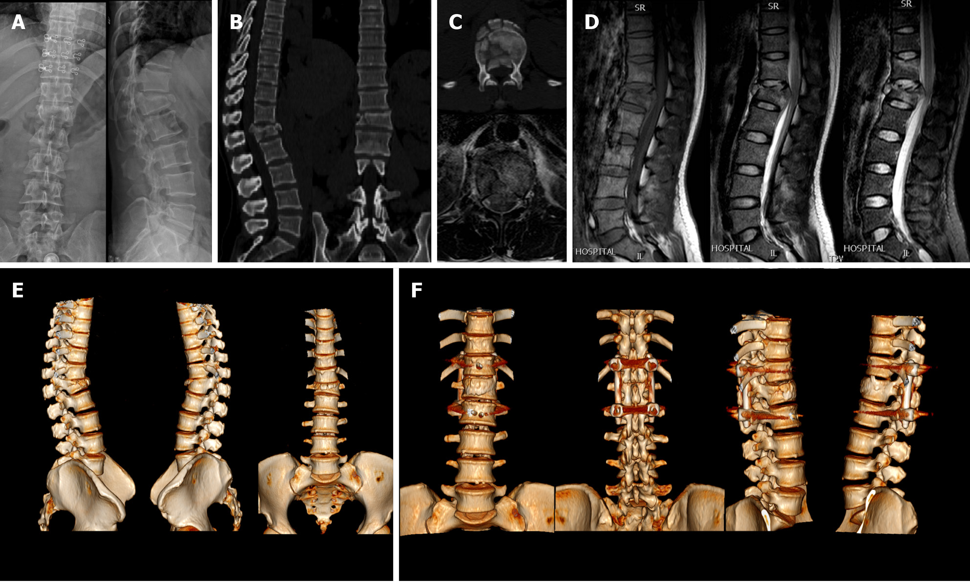 The Radiology Assistant : TLICS Classification of fractures