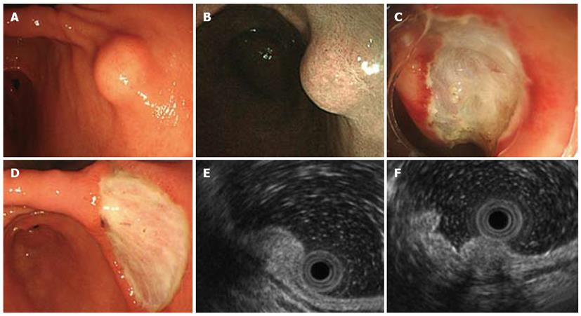 Gastric calcifying fibrous tumor removed by endoscopic submucosal