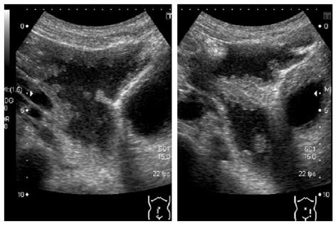 what is malignant effusion