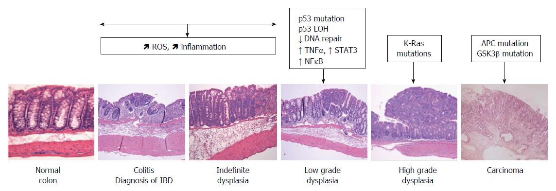 can-low-grade-dysplasia-be-cancer-cancerwalls