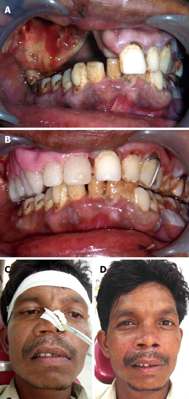 oral cancer surgery