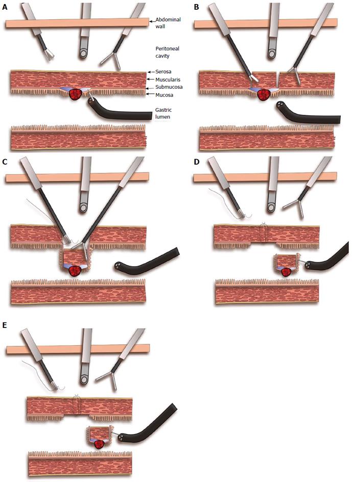 Cooperative laparoscopic endoscopic and hybrid laparoscopic surgery for ...