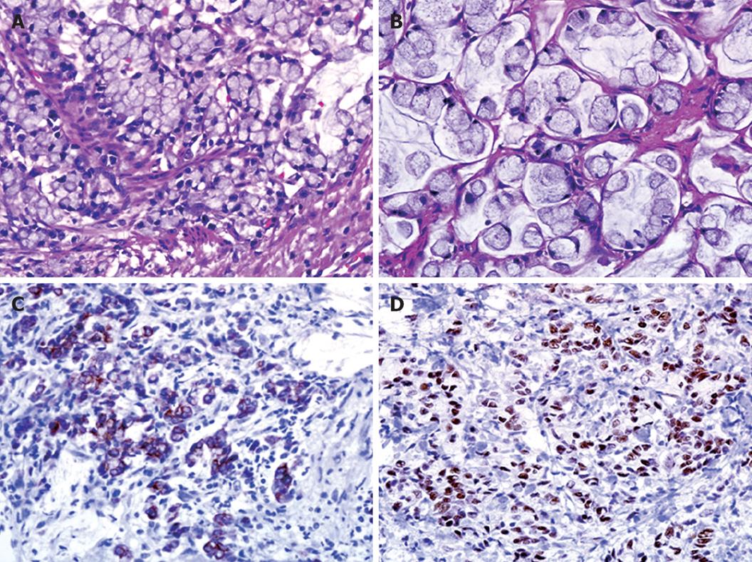Primary signet ring cell carcinoma of uterine cervix and related disease:  two case reports and a review | International Cancer Conference Journal