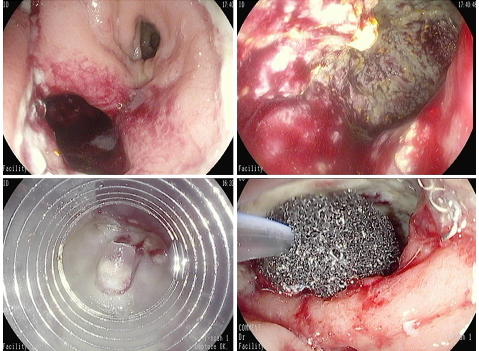 Endoscopic management of gastrointestinal leaks and fistulae: What option  do we have?
