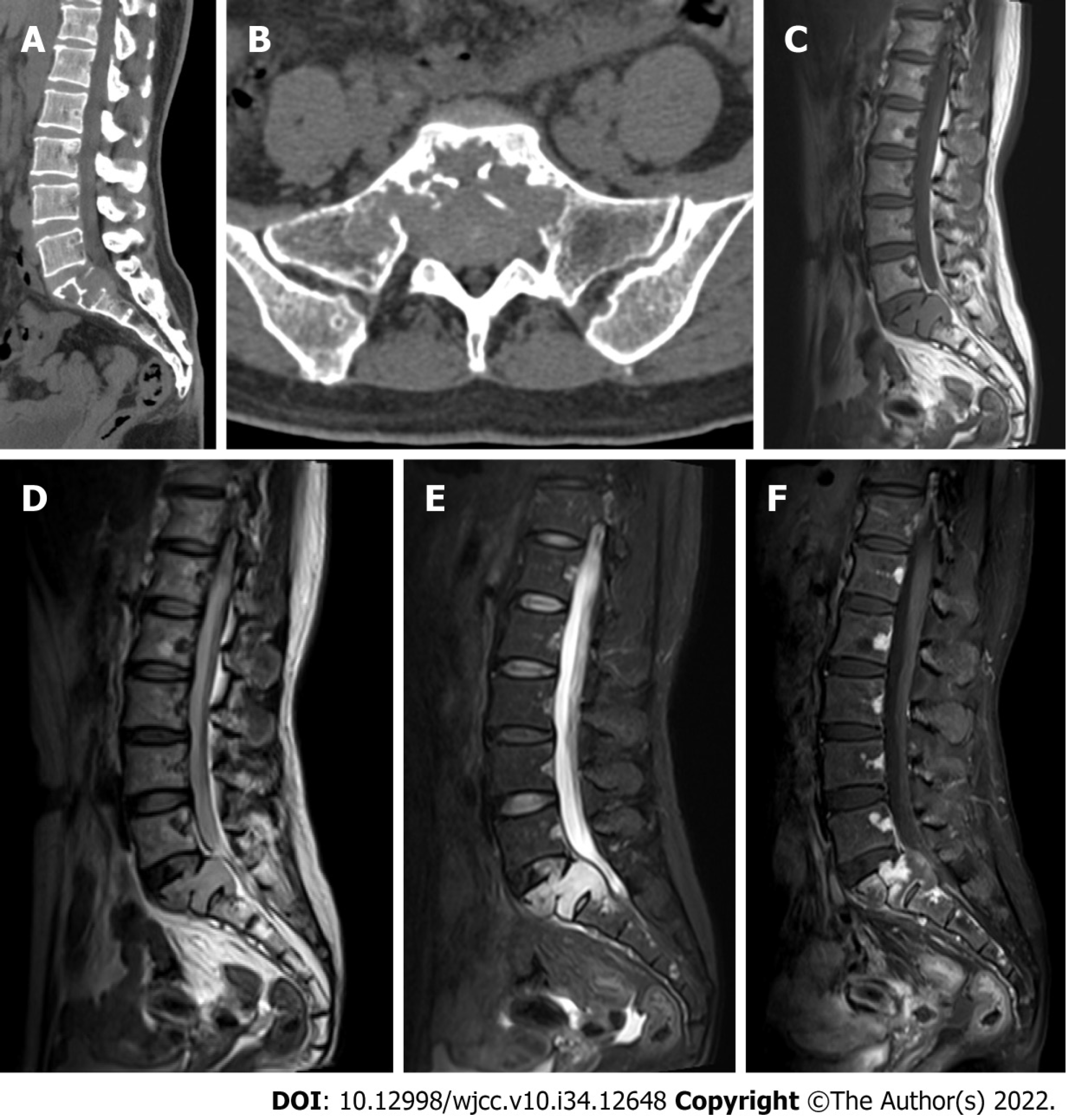 Hemangioma Mri Vertebral Hemangioma Mri Vertebral