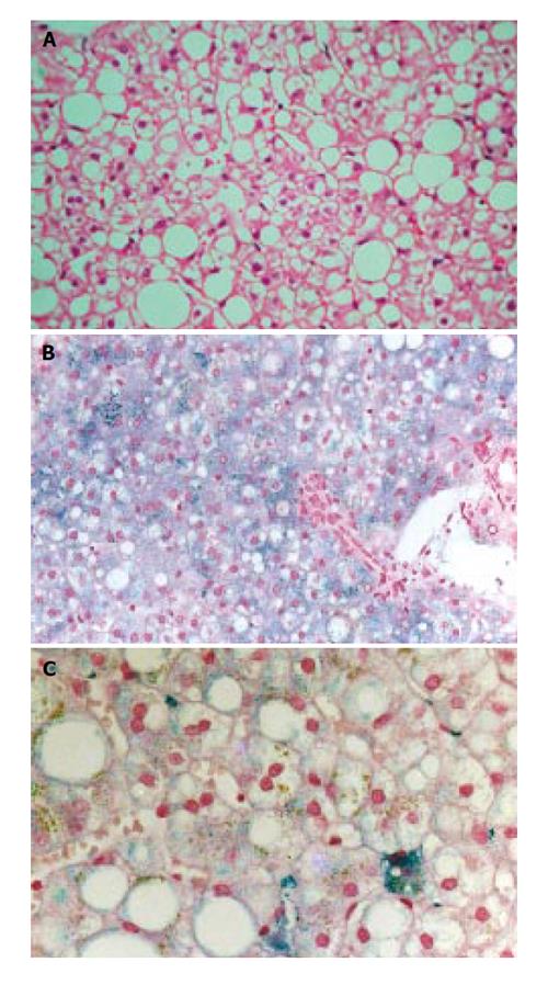 Fatty liver in H63D homozygotes with hyperferritinemia