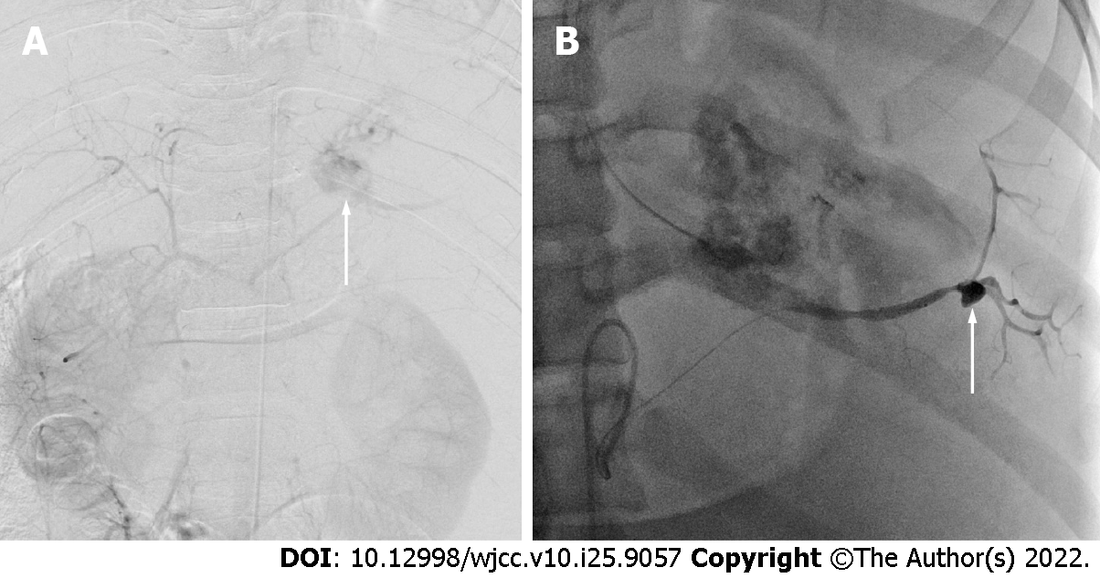 Ruptured Splenic Artery Aneurysms In Pregnancy And Usefulness Of