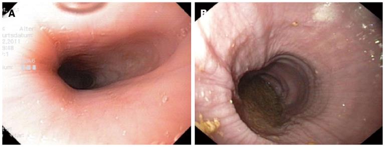 achalasia endoscopy