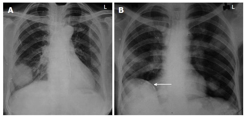 Diagnosis of systemic lupus erythematosus with early manifestation of an  eosinophilic pleural effusion | BMJ Case Reports
