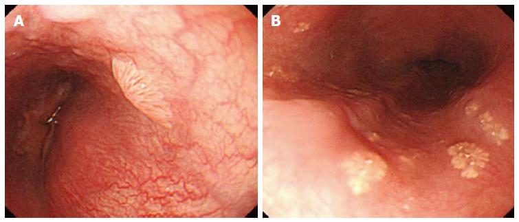 esophageal papilloma surveillance