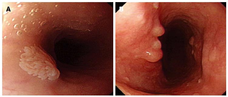 esophageal squamous papillomas