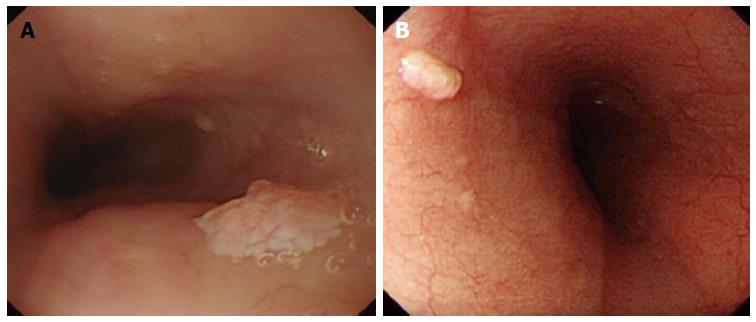 squamous papilloma esophagus hpv uomo portatore