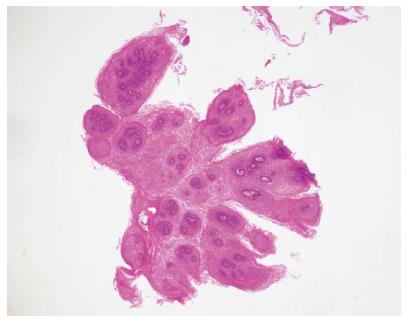 esophageal papilloma pathology