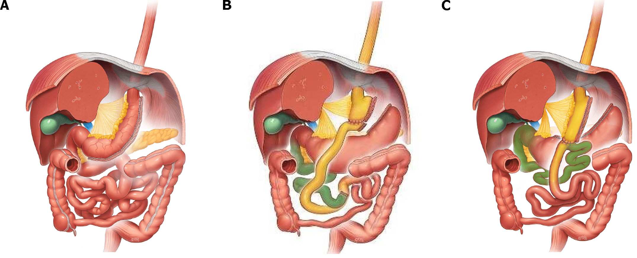 Roux-en-Y Gastric Bypass - Trial Exhibits Inc.