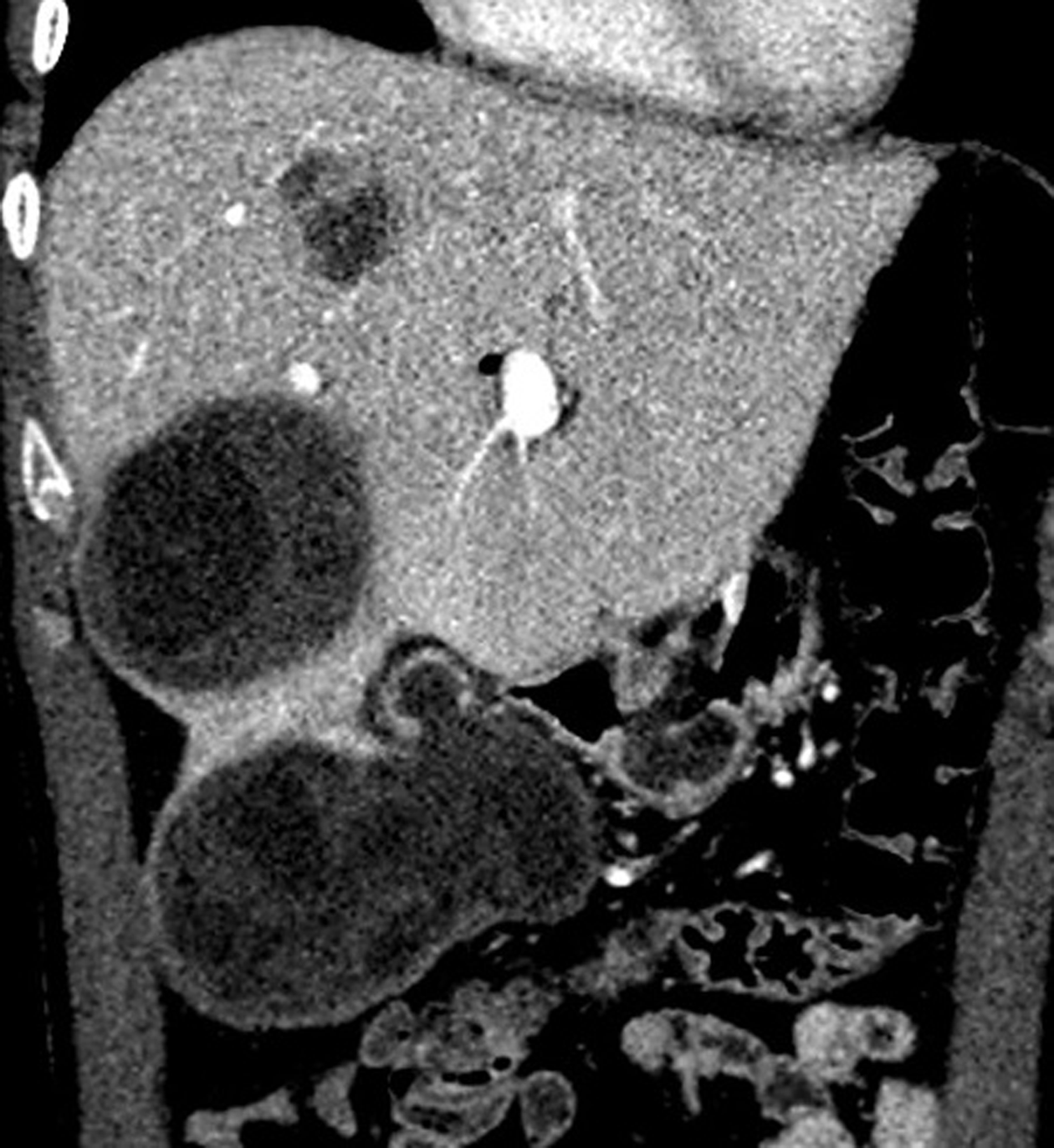 Intraperitoneal Rupture Of The Hydatid Cyst Four Case Reports And