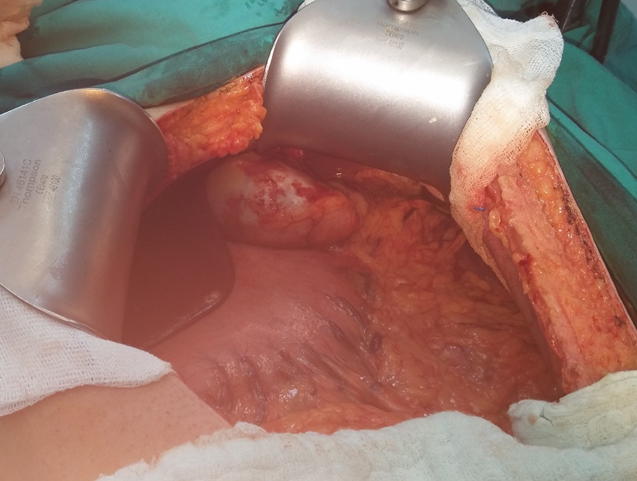 Intraperitoneal rupture of the hydatid cyst: Four case reports and