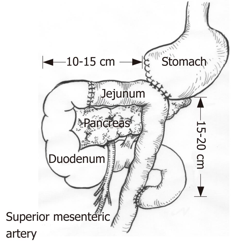 Superior Mesenteric Artery Syndrome Treatment